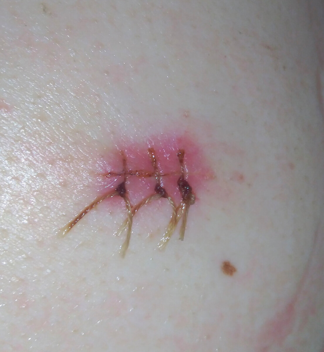 Правильно удаленная подозрительная родинка должна выглядеть так. Ее вырезает онколог и накладывает хирургический шов