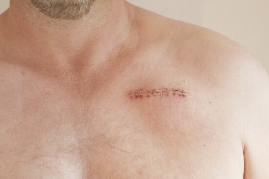 Так выглядит место имплантации кардиостимулятора