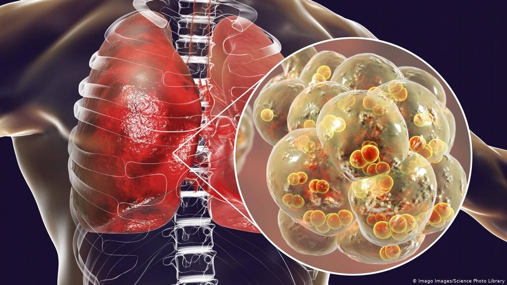 Альвеолы легких, пораженных коронавирусом