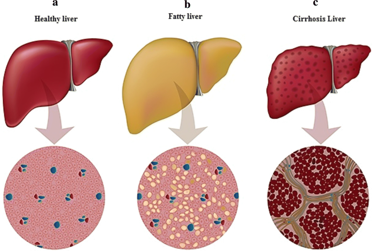 Слева направо: здоровая печень,печень с жировой дистрофией, печень с фиброзом 