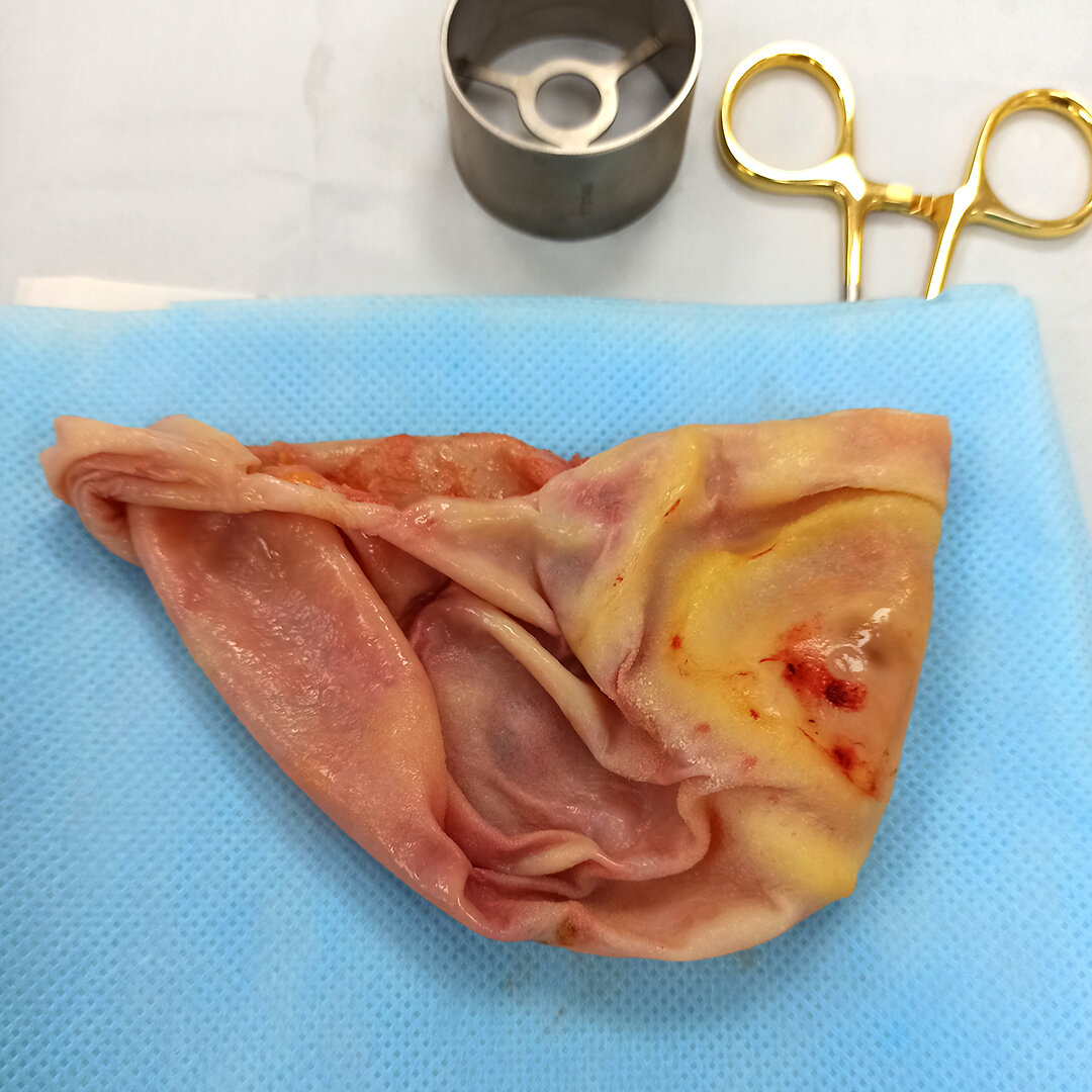 Капсула имплантата