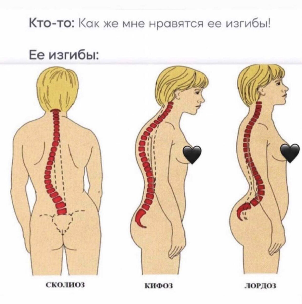 S-образный сколиоз - лечение без операции