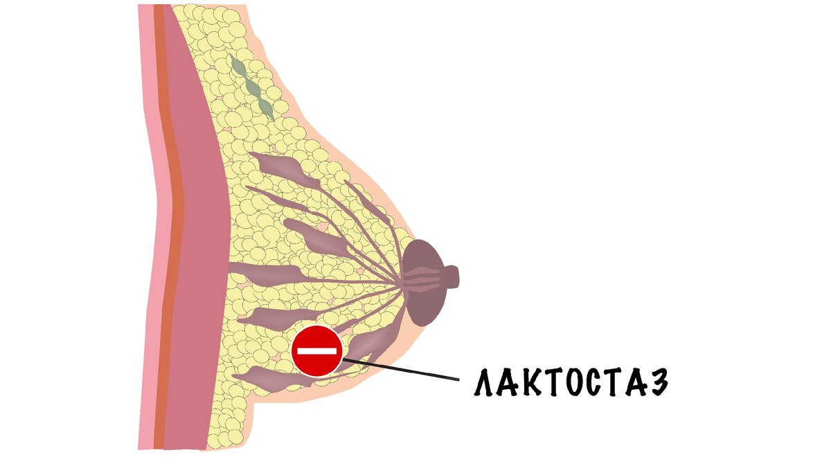 Лактостаз: симптомы, причины, лечение, последствия