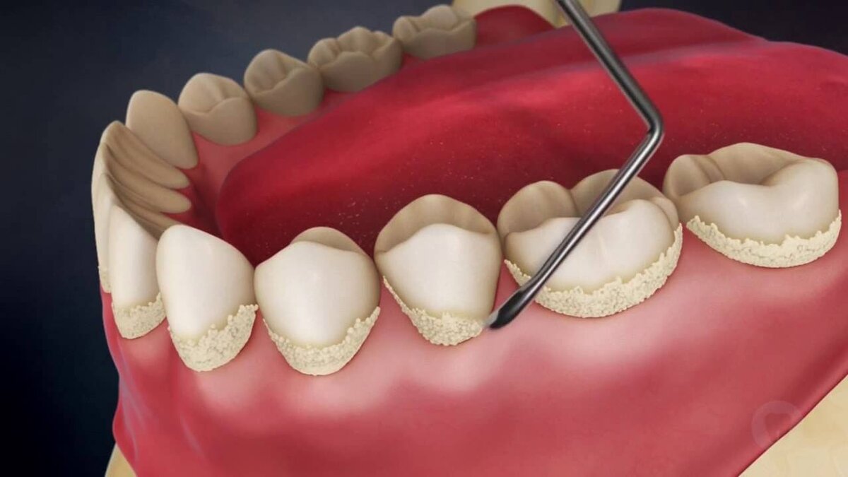 Снятие зубных отложений относится к профилактике и проводится механическим путем.