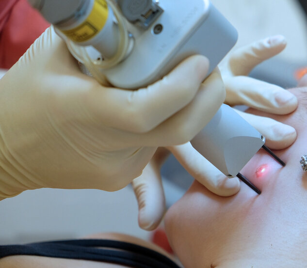 Удаление бородавки с помощью лазерной технологии.