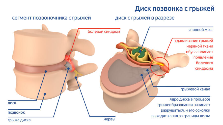 Межпозвоночная грыжа где находится картинки