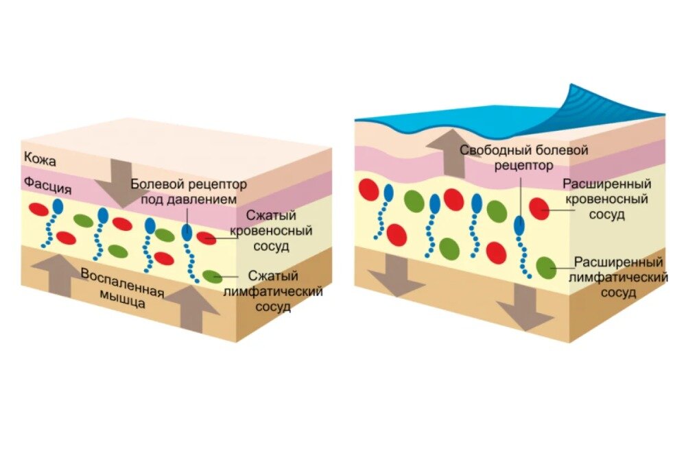 механизм действия тейпов. как работает тейпирование. как работают тейпы. тейпирование икроножной мышцы. как работают тейпы.