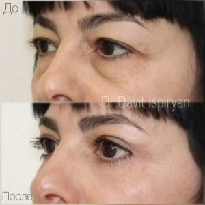 Блефаропластика фото до и после. Фото с сайта пластического хирурга Давита Испиряна. Имеются противопоказания, требуется консультация специалиста