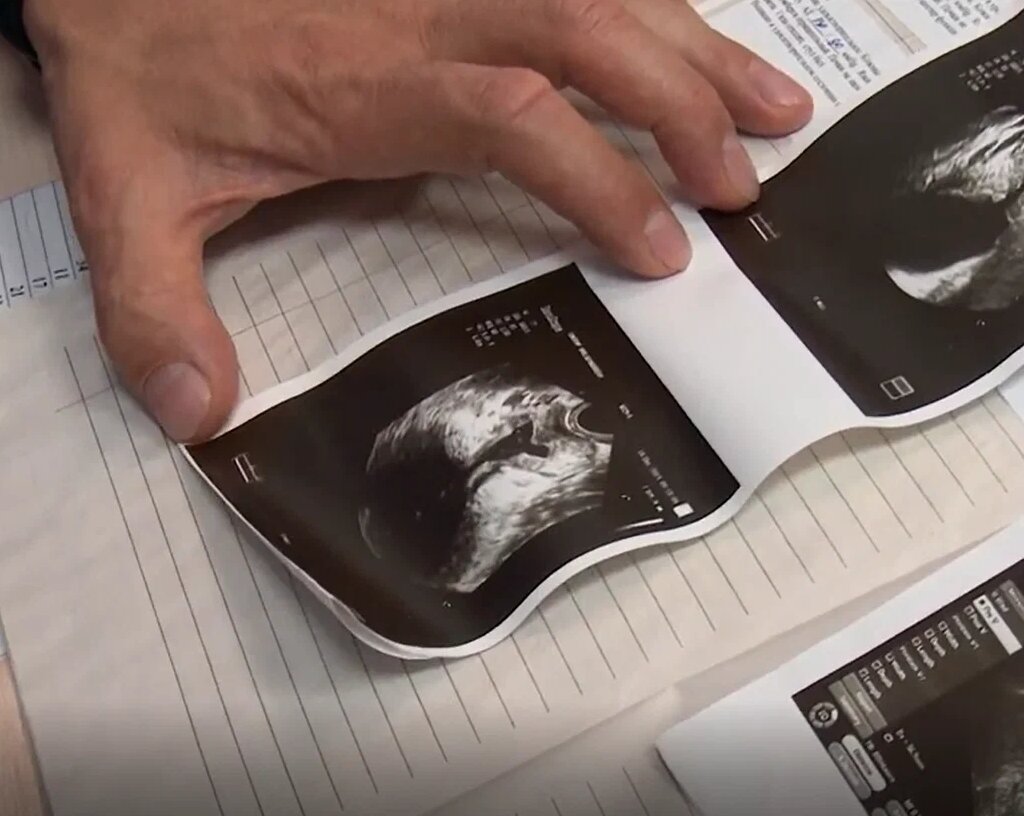 Аденома простаты. | Клинический центр «Медиаль» Г. Ижевск | Дзен