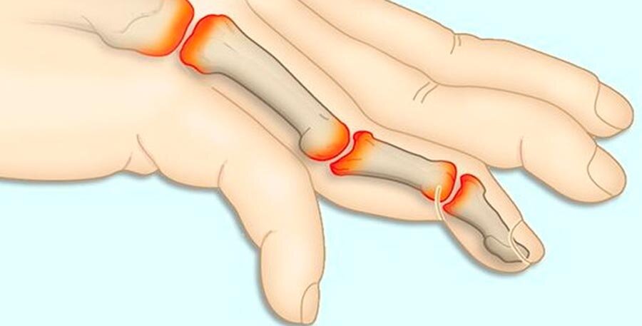 Ревматоидного артрита