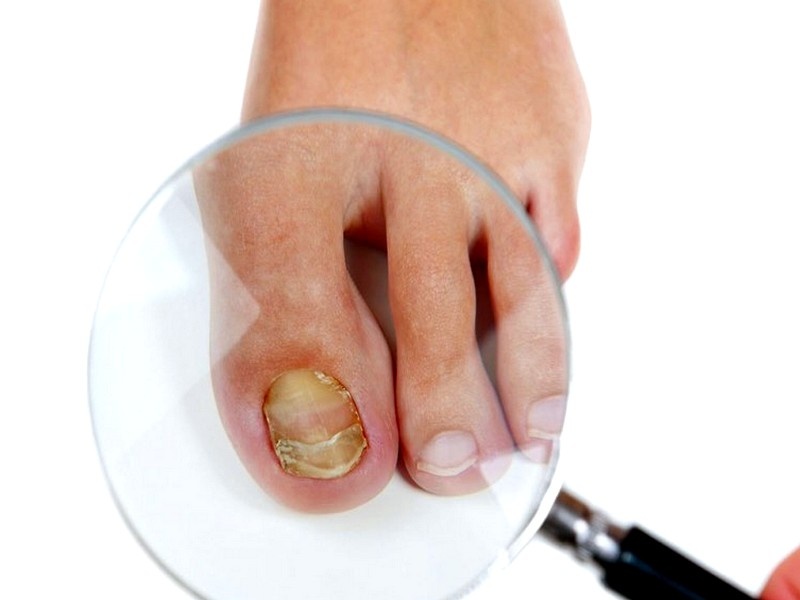 ОНИХОМИКОЗ