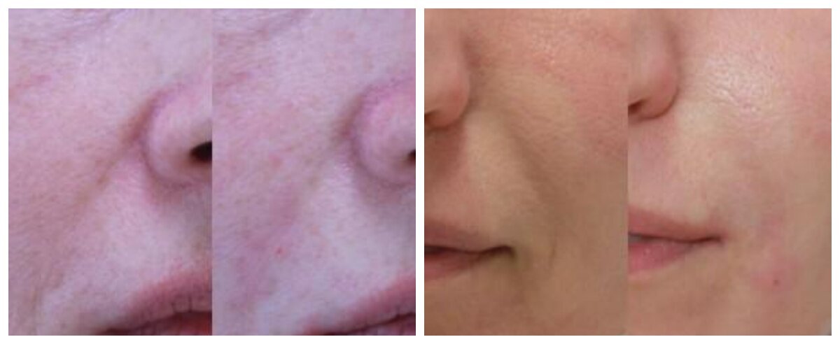 Коррекция носогубной складки фото до и после. Фото с сайта Д.Р. Гришкяна. Имеются противопоказания, требуется консультация специалиста