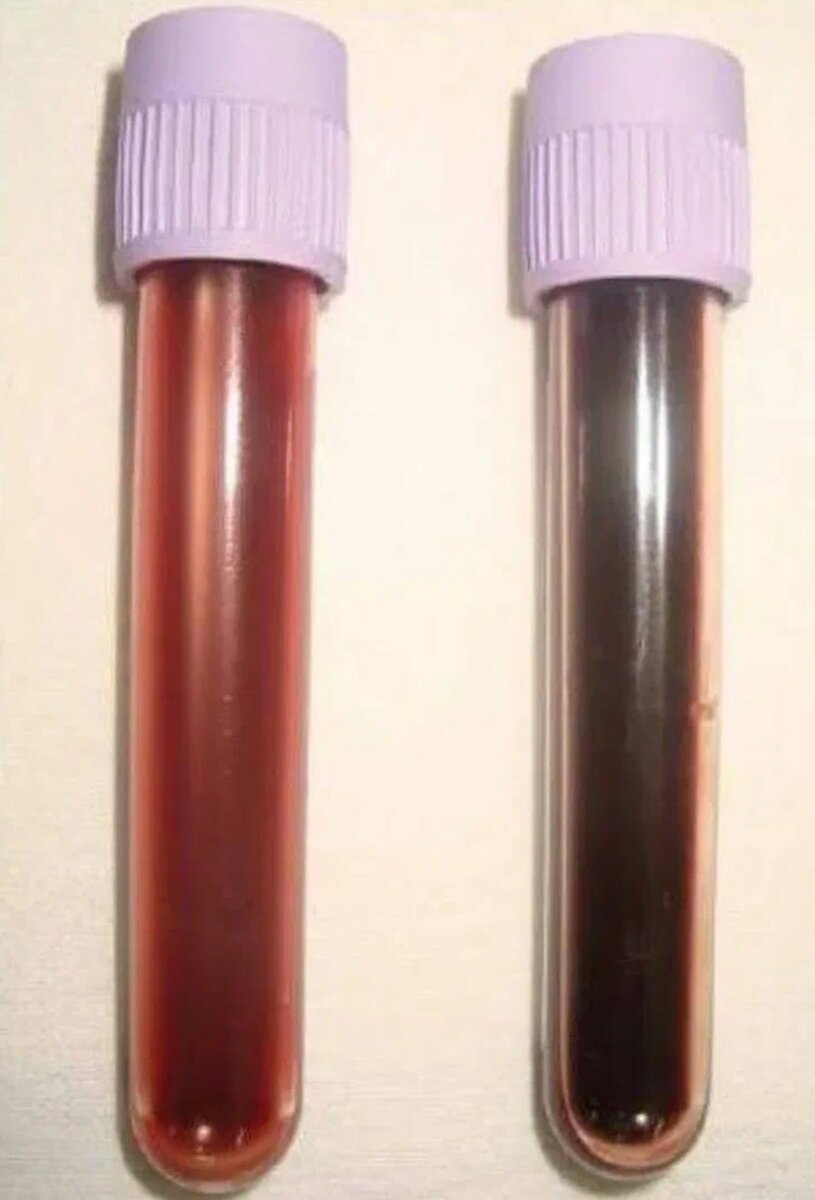 Слева- венозная кровь с нормальным уровнем метгемоглобина. Справа-кровь с повышенным содержанием метгемоглобина ("шоколадная" кровь).