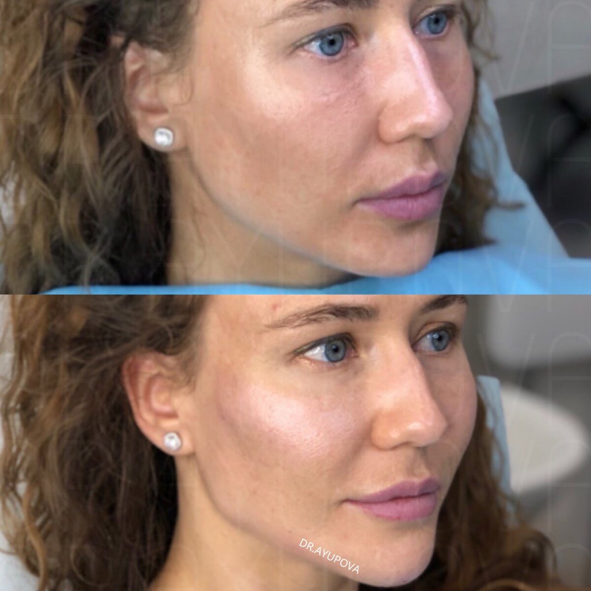 оплывший овал лица. поплыло лицо вниз что делать. поплыл овал лица. поплыло лицо вниз что делать. подтяжка лица нитями до и после.