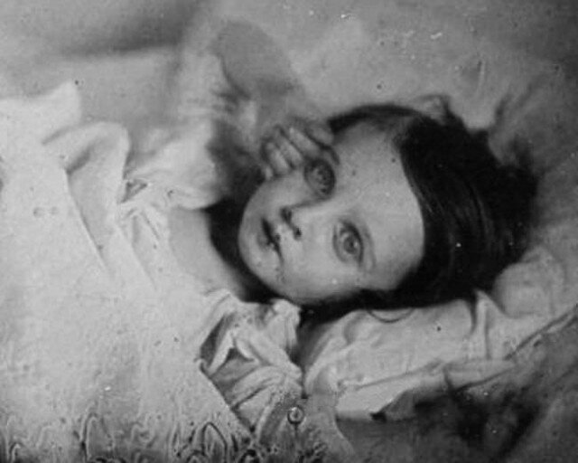 Пост-мортем. Умершая девочка.