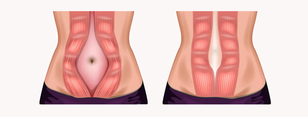 Диастаз живота у женщин. Диастаз прямой мышцы живота. Диастаз пупочного кольца.