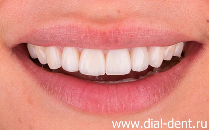 пример протезирования зубов керамическими коронками