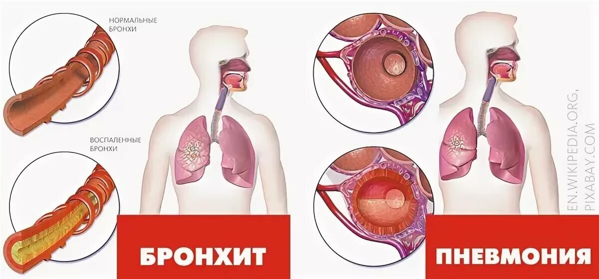 Как отличить бронхит от пневмонии