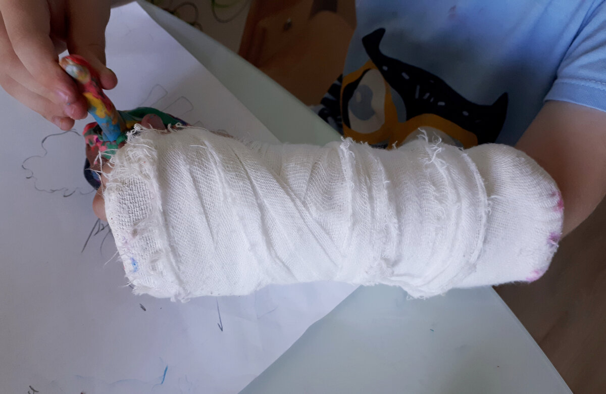 Гипс лепке не помеха