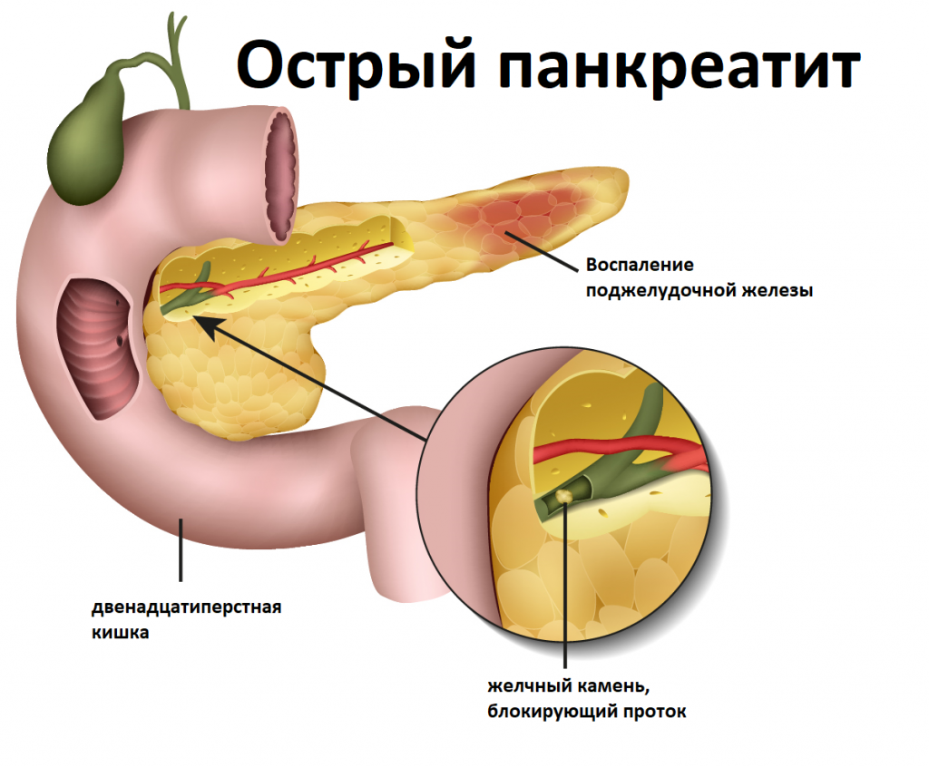 Хронический панкреатит рисунок