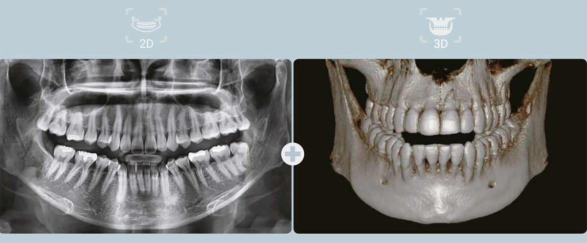 Кт нижней челюсти цена в ульяновске. Кт двух челюстей VATECH 12x8.5. Кт 3d верхней и нижней челюсти. Кт 2-3 зубов VATECH. 3д кт сканирование челюстной.
