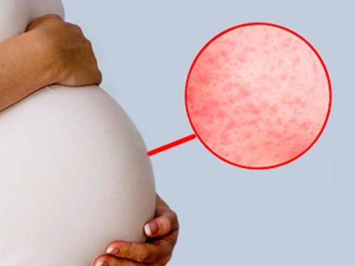 Инфекции на ранних сроках беременности. Инфекции на ранних сроках беременности. Памятка для беременных. Влияние инфекционных заболеваний на плод. Первые симптомы беременности.