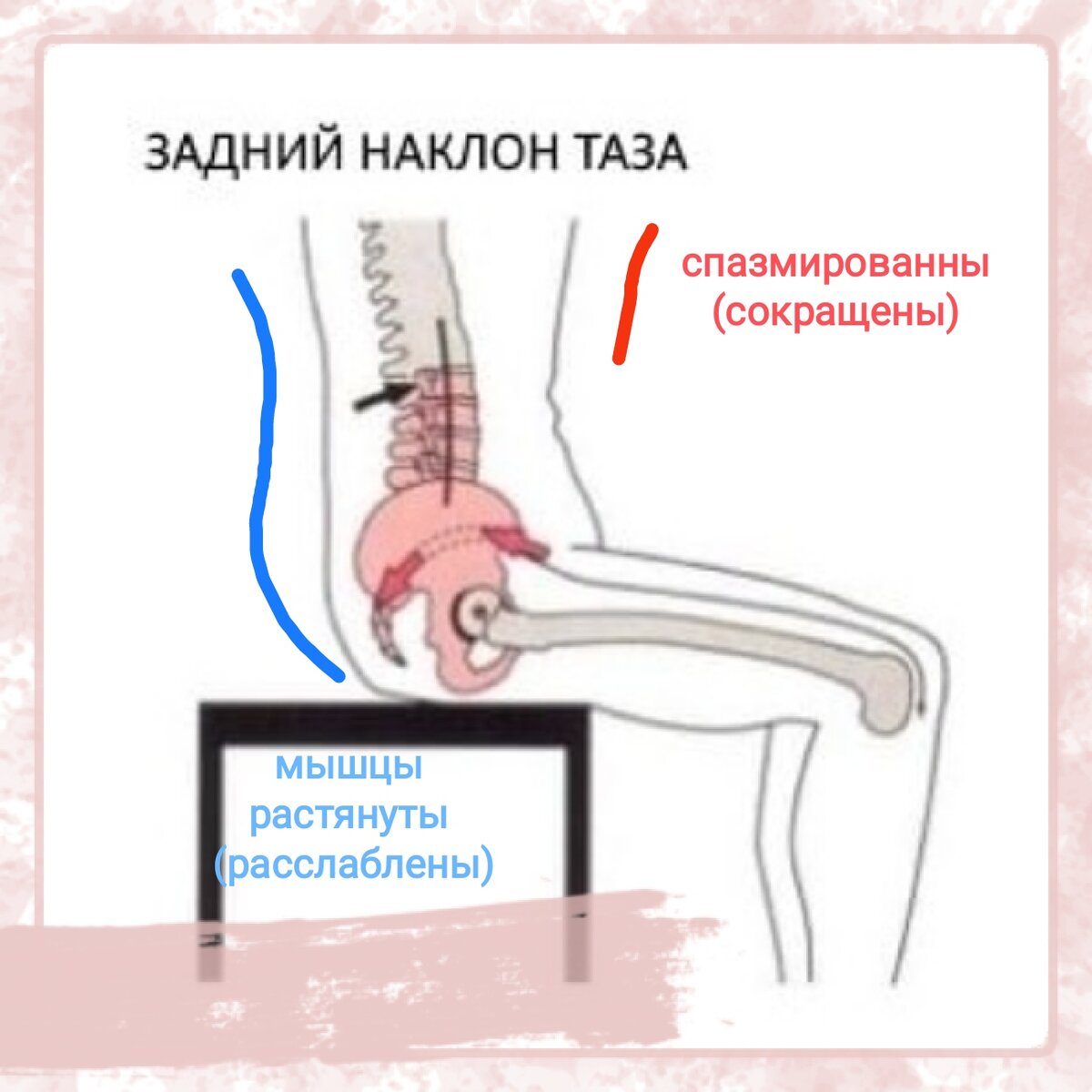 Наклон таза назад и сколиоз есть ли взаимосвязь? | Студия Активного  Здоровья 50+ | Дзен