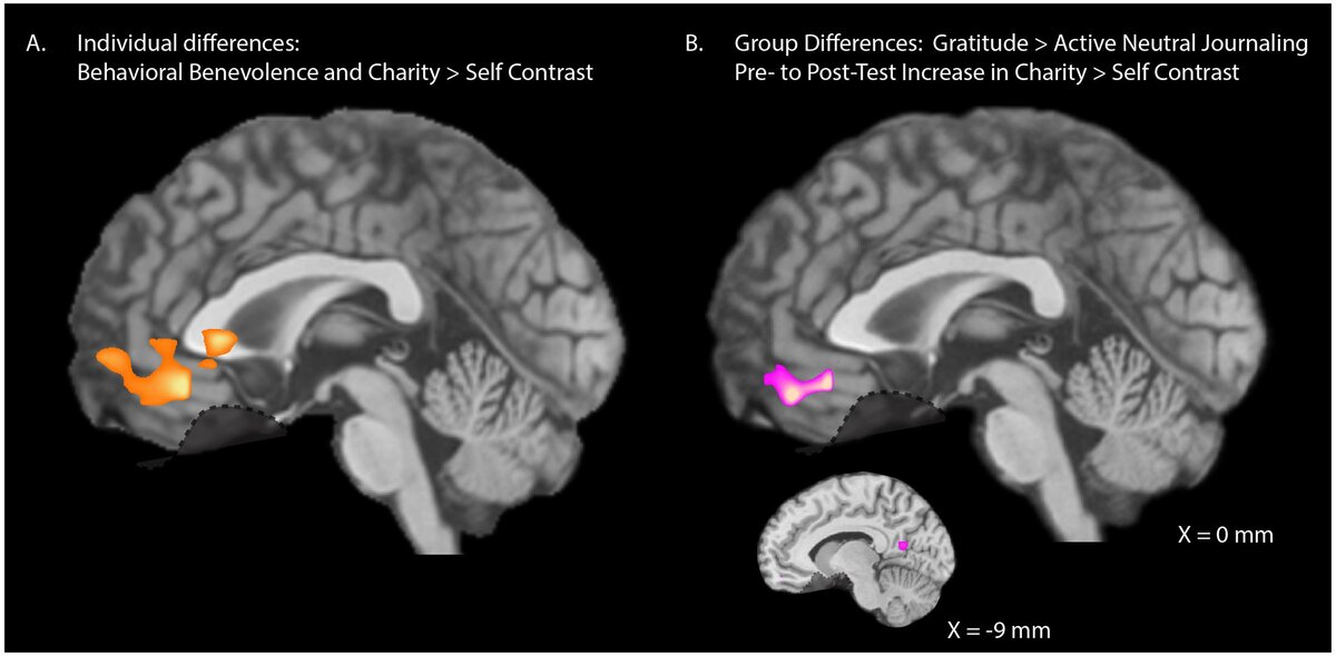 Исследования магнитно-резонансной томографии. Благотворительность вызывает активизацию центров вознаграждения в мозге (Источник фото: https://www.frontiersin.org/articles/10.3389/fnhum.2017.00599/full)