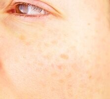 Пример пигментных пятен на лице. 