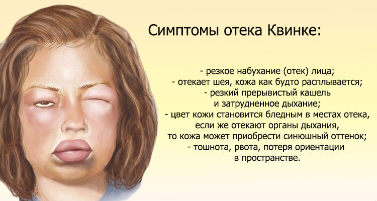 Карта отек квинке