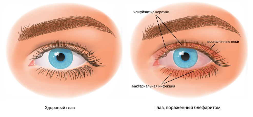 Симптомы блефарита
