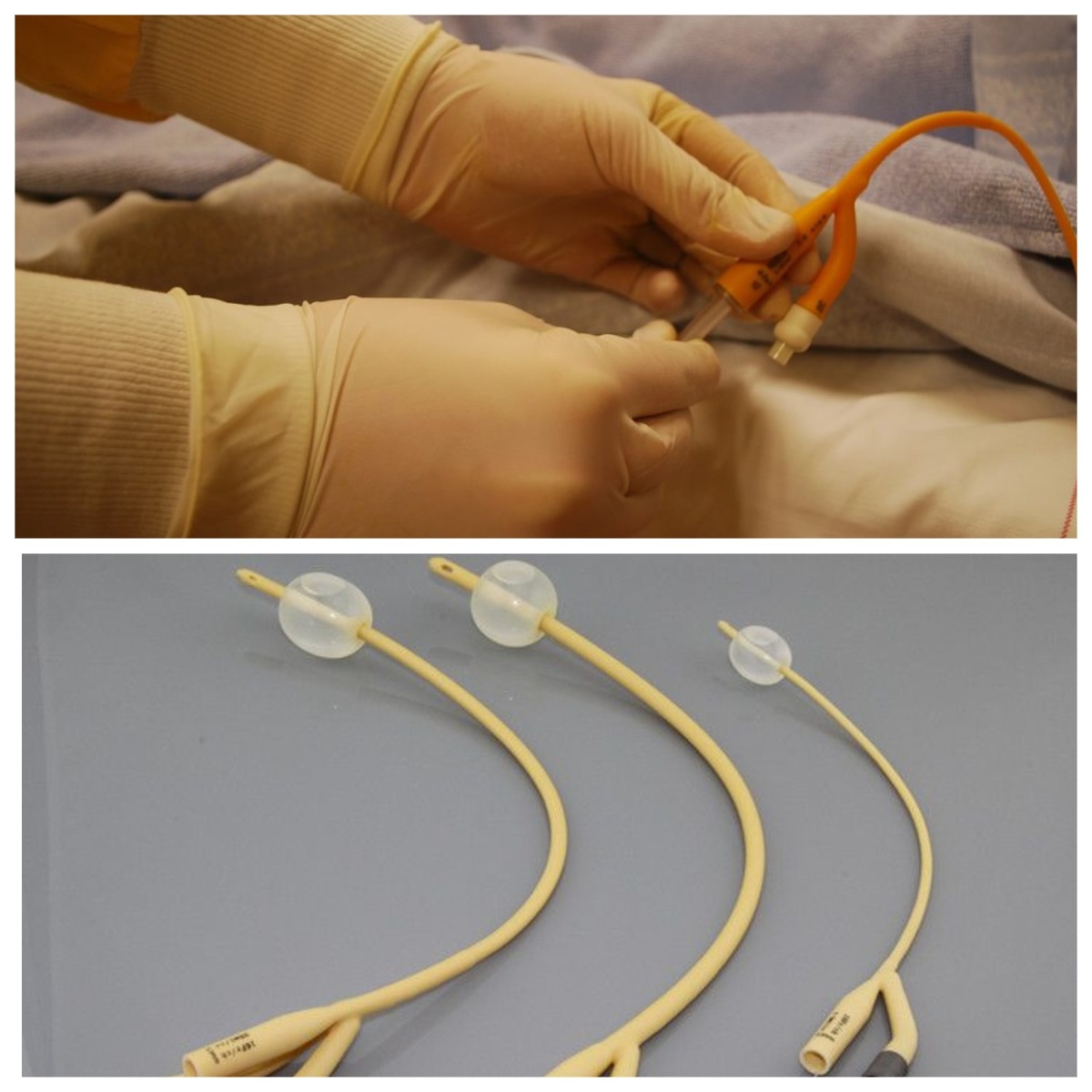 Катетер вводят в канал шейки и раздувают баллончик с помощью вводимой жидкости. 