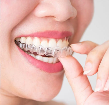 Плюсы и минусы лечения элайнерами