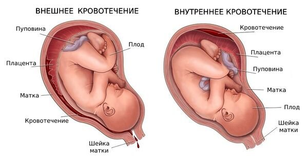 Поздняя имплантация эмбриона при ЭКО
