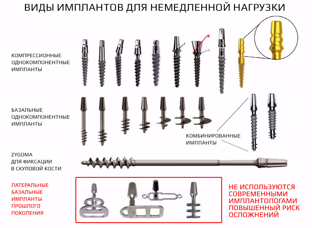 Виды зубных имплантов