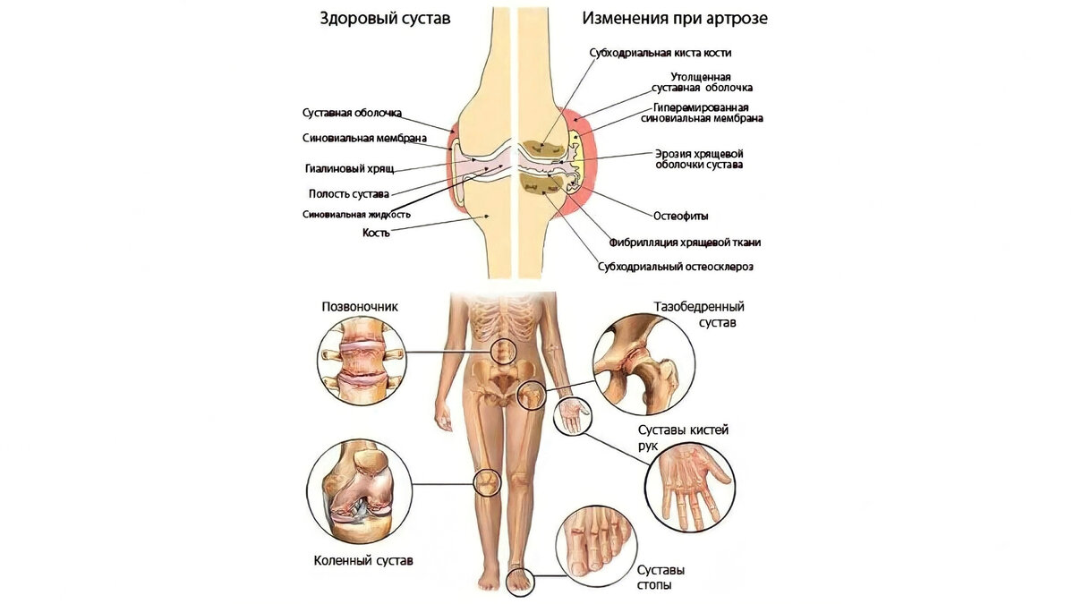 Артрит – не путать с артрозом: как диагностируют и лечат эти заболевания |  Павел Корпачев | Дзен