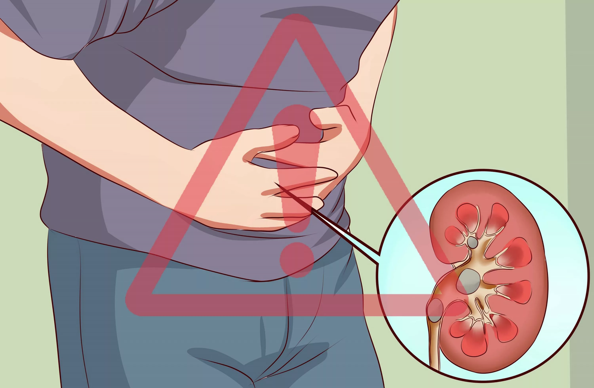 Мочекаменная болезнь иррадиация боли. Нефролитиаз почек что это такое симптомы. Камень из почки симптомы. КАМНИТВ почках симптомы.