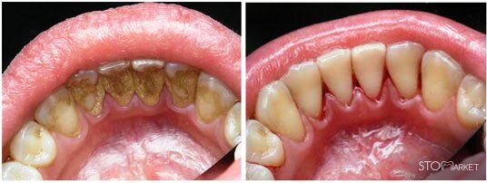 Зубной камень – это отвердевший налет (иногда он также называется зубная бляшка). Может быть наддесневым, тогда его можно увидеть невооруженным глазом, и поддесневым, в этом случае обнаружить его может только врач-стоматолог. Наиболее частая причина возникновения – неправильная или редкая чистка зубов. Налет образуется очень быстро, процесс запускается буквально через несколько минут после чистки. Минерализованные отложения – распространенная проблема, она наблюдается примерно у 90% пациентов стоматологических клиник. Обычно цвет отложений – желтый или коричневый, и проблема это не только косметическая, но и влекущая различные патологии (гингивит, кариес, кровоточивость десен, подвижность зубов, запах изо рта). Дети в меньшей степени подвержены этой неприятности, однако если вы заметили пожелтение зубов или ребенок жалуется на кровоточивость десен, лучше обратиться к врачу. 