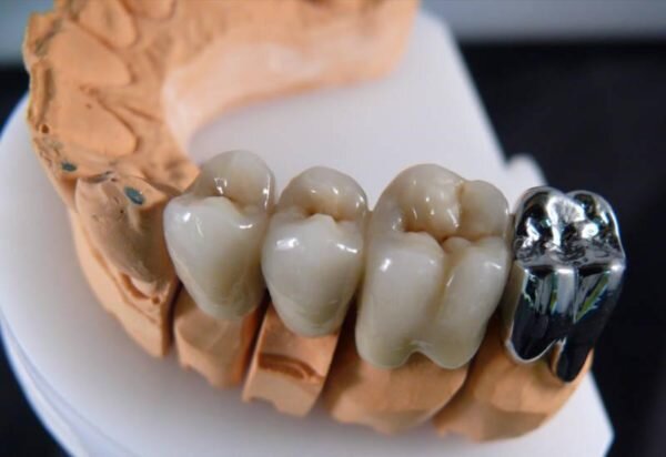 Зубной мост на жевательные зубы