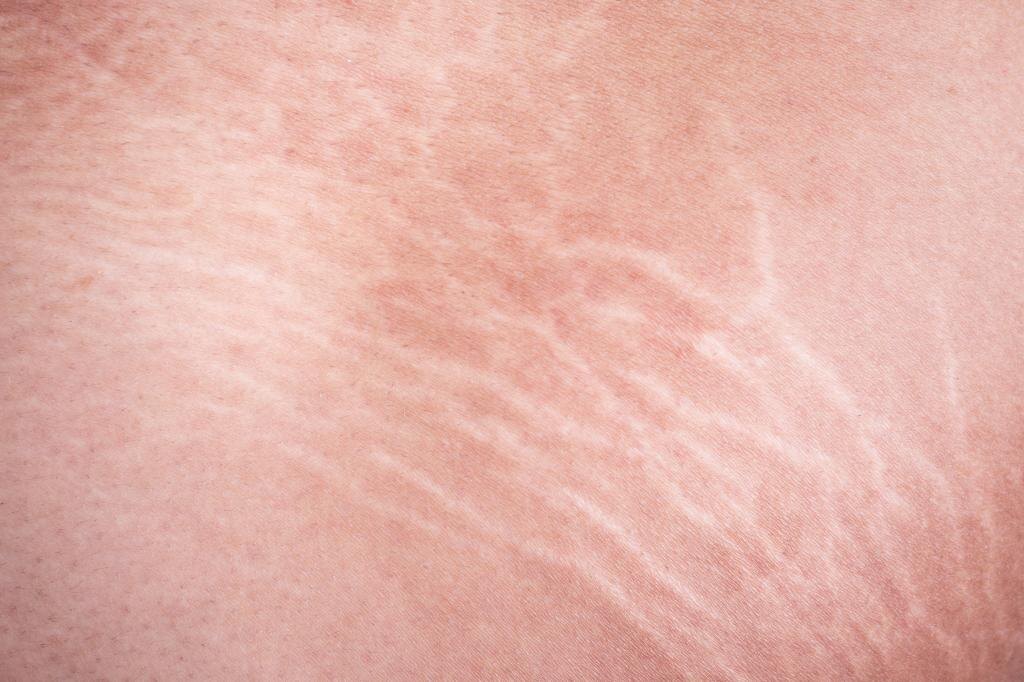 Растяжки. Фото из интернета.