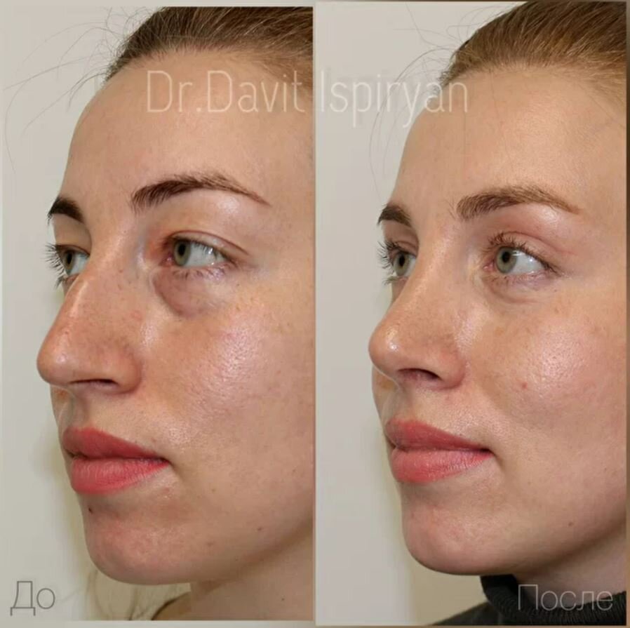 Ринопластика носа и круговая блефаропластика фото до и после. Фото с сайта пластического хирурга Давита Испиряна. Имеются противопоказания, требуется консультация специалиста