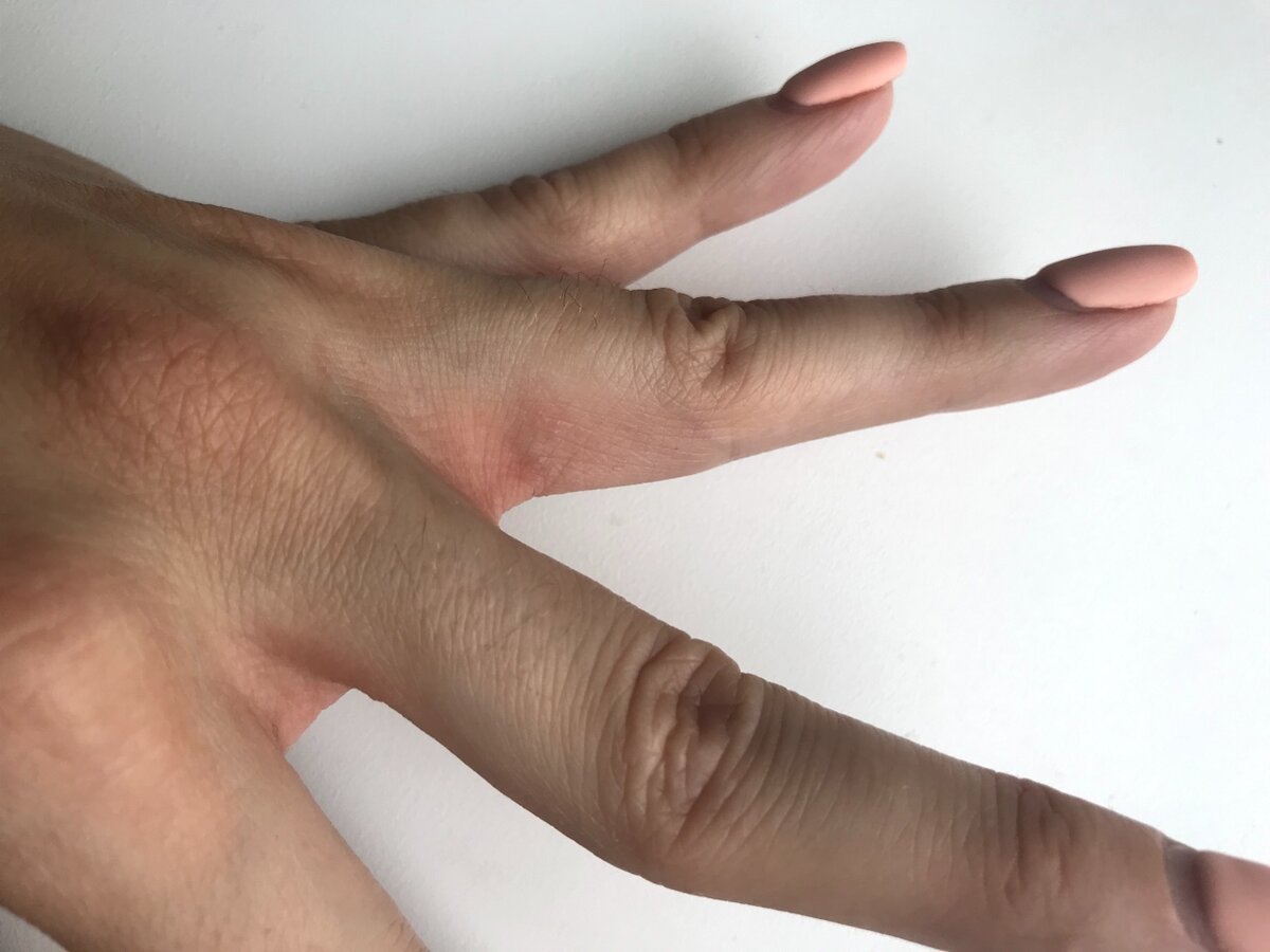 Трещины между пальцев рук