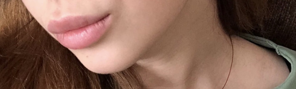 Губы после того, как сошёл оттёк.