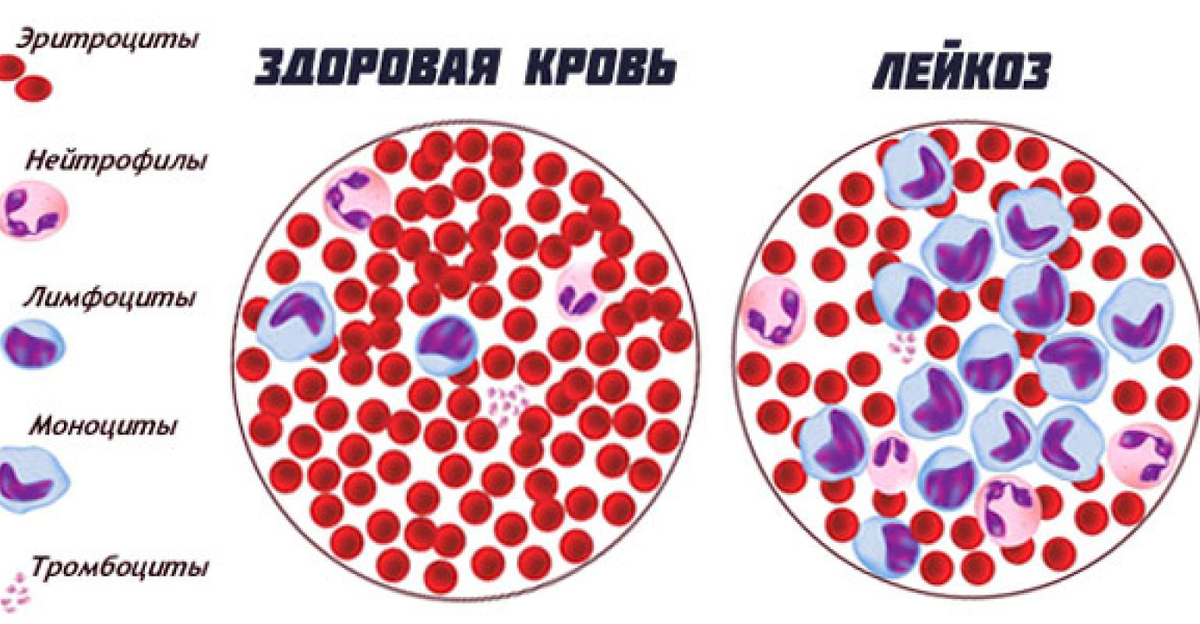 Картина крови при лейкозе у детей