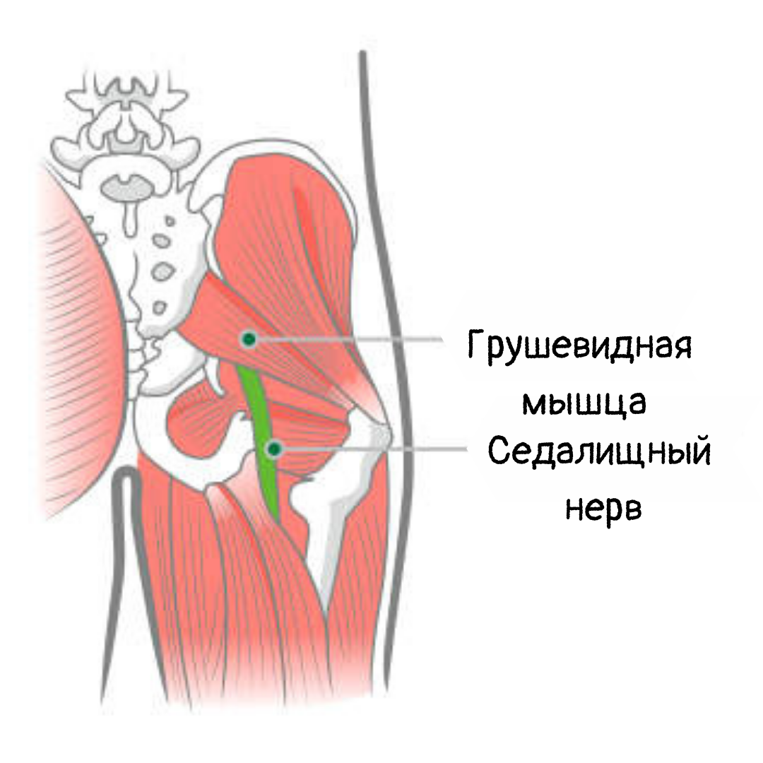 Синдром грушевидной мышцы картинки