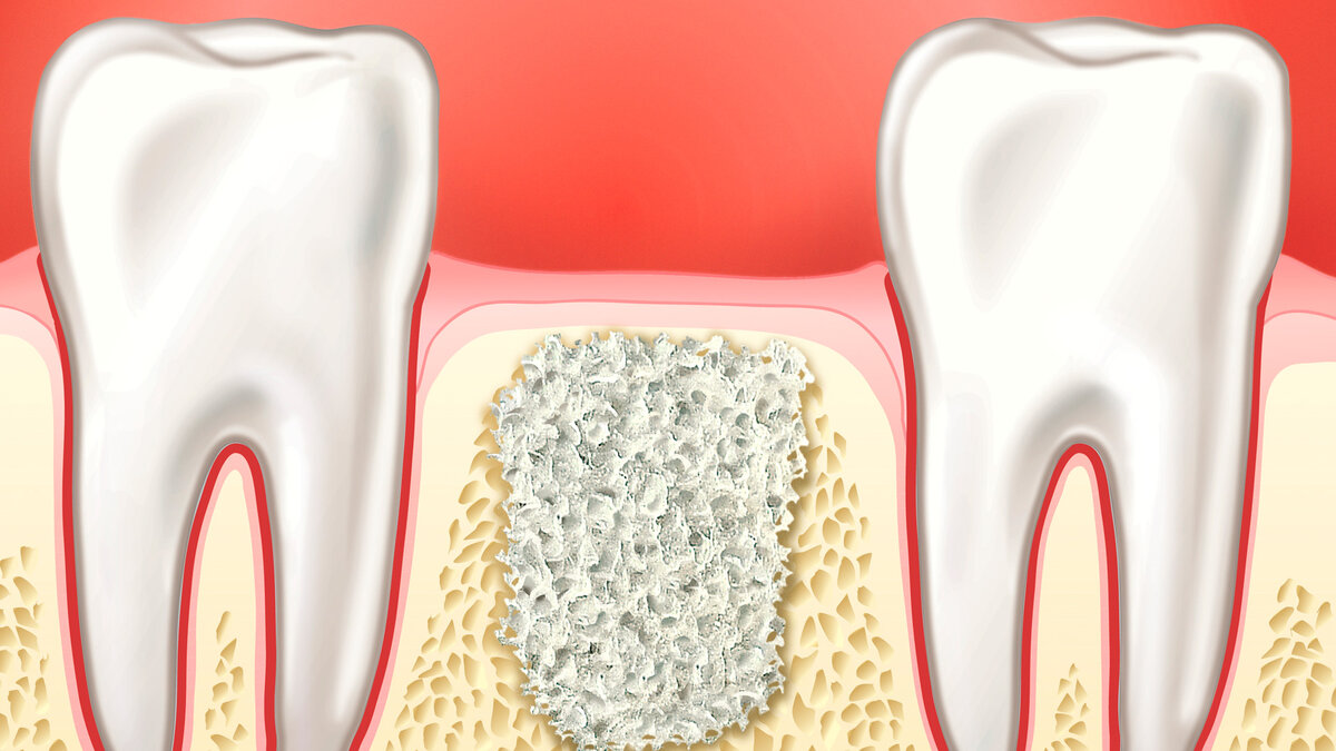Остеопластика поможет восстановить костную ткань челюсти. Картинка из свободных источников.