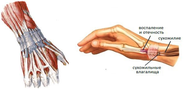 Воспаление запястного сустава. Тендовагинит сухожилий лучезапястного. Тендовагинит разгибателей пальцев. Воспаление сухожилия тендовагинит. Крепитирующий тендовагинит сухожилий.