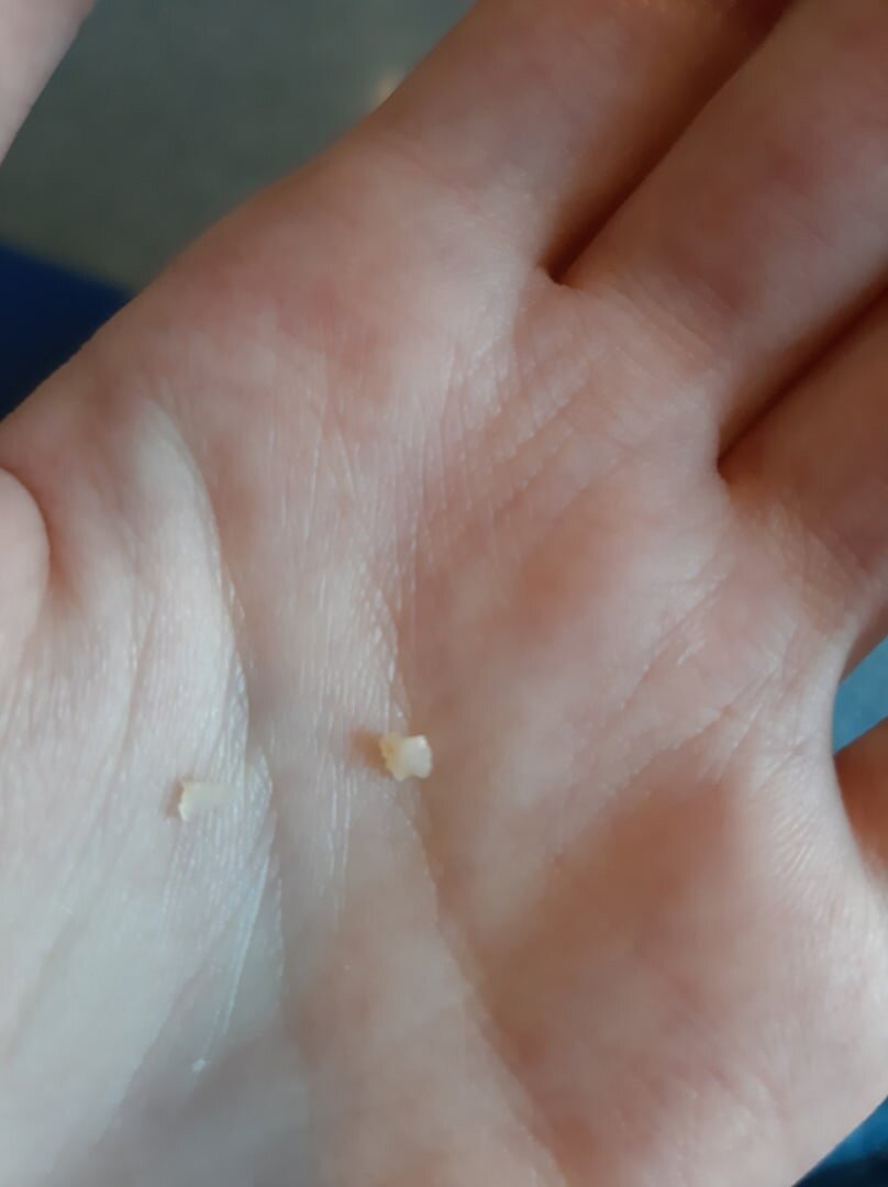 Крошки зуба