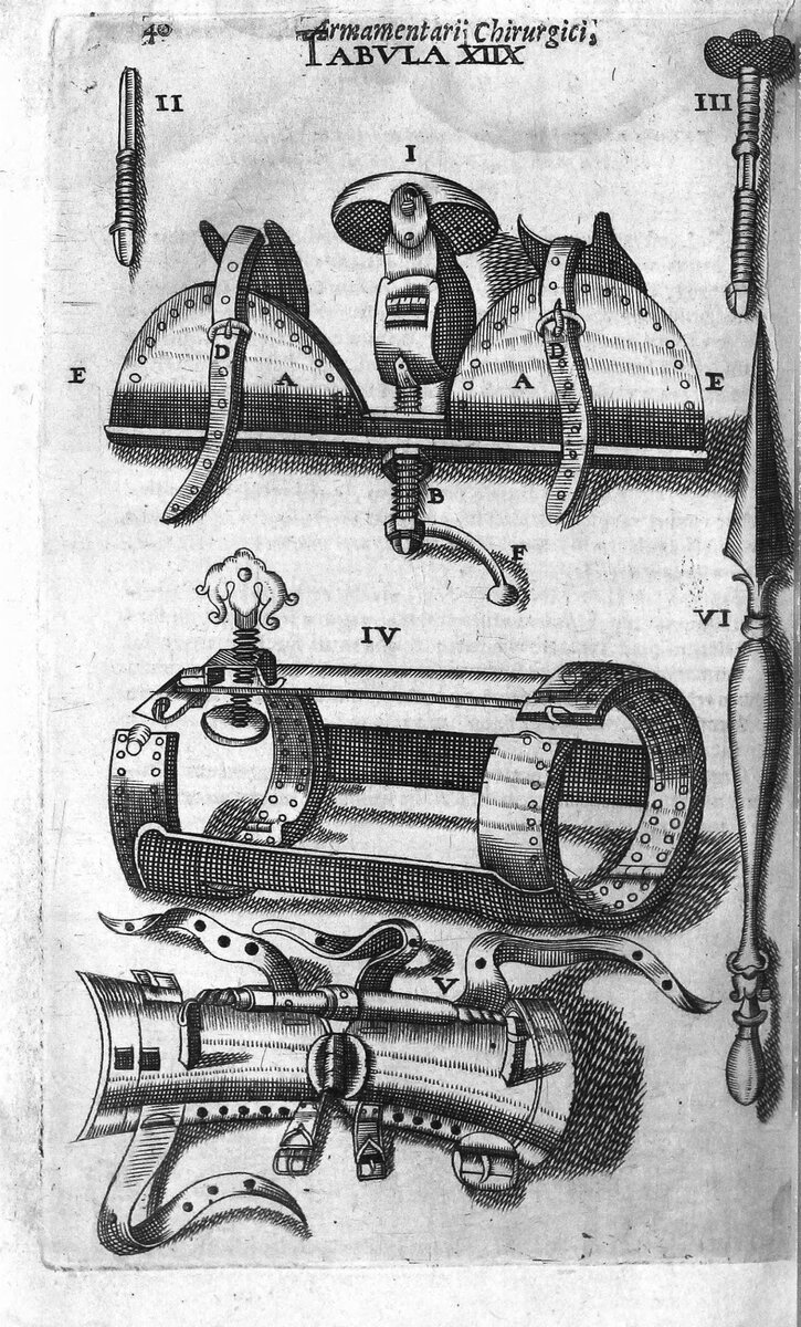 Гравюра из книги Shultes J. Armamentarium Chirurgicum, 43 Tabulis Aeri Elegantissime Incisis, Nec Ante Hac Visis, Exornatum. 1665.