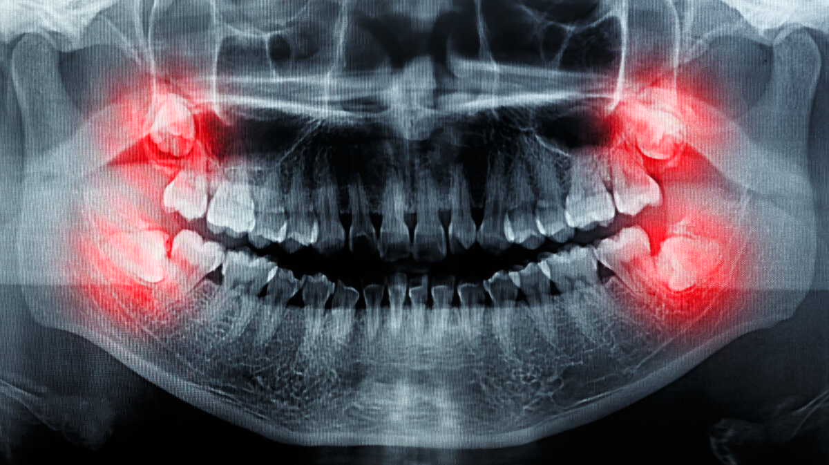 Ретинированный зуб мудрости рентген. Ортопантомограмма зубы мудрости. Ретинированный зуб на ОПТГ. Зуб мудрости рентген снимок.
